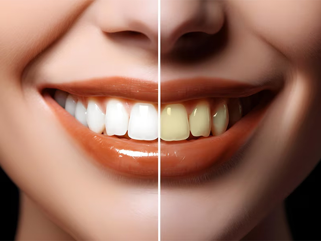 Teeth Whitening Hillcrest Dental Care Pittsfield MA, Dentists Pittsfield MA, Dental In The Berkshires