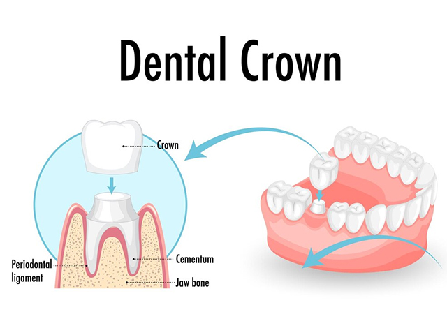 Dental Crowns Hillcrest Dental Care Pittsfield MA, Dentists Pittsfield MA, Dental In The Berkshires