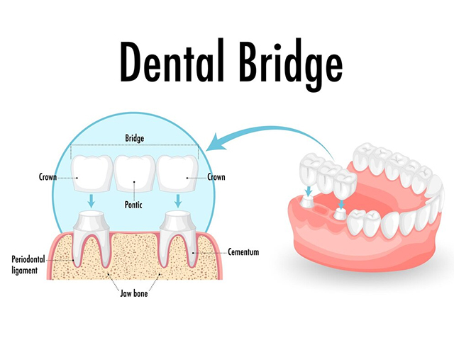 Dental Bridge Hillcrest Dental Care Pittsfield MA, Dentists Pittsfield MA, Dental In The Berkshires